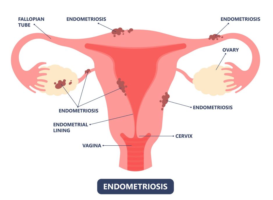 Uterus with Endometriosis